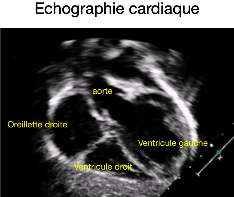 échographie précoce pas de battement de coeur 